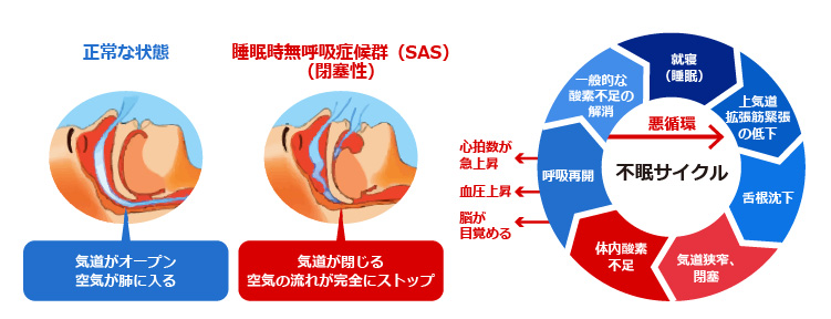 【正常な状態】気道がオープン 空気が肺に入る　【睡眠時無呼吸症候群（SAS）（閉塞性）】気道が閉じる 空気の流れが完全にストップ　　悪循環　不眠サイクル